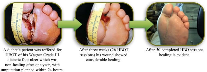Wound-Healing-HBOT